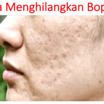 Cara Menghilangkan Bopeng